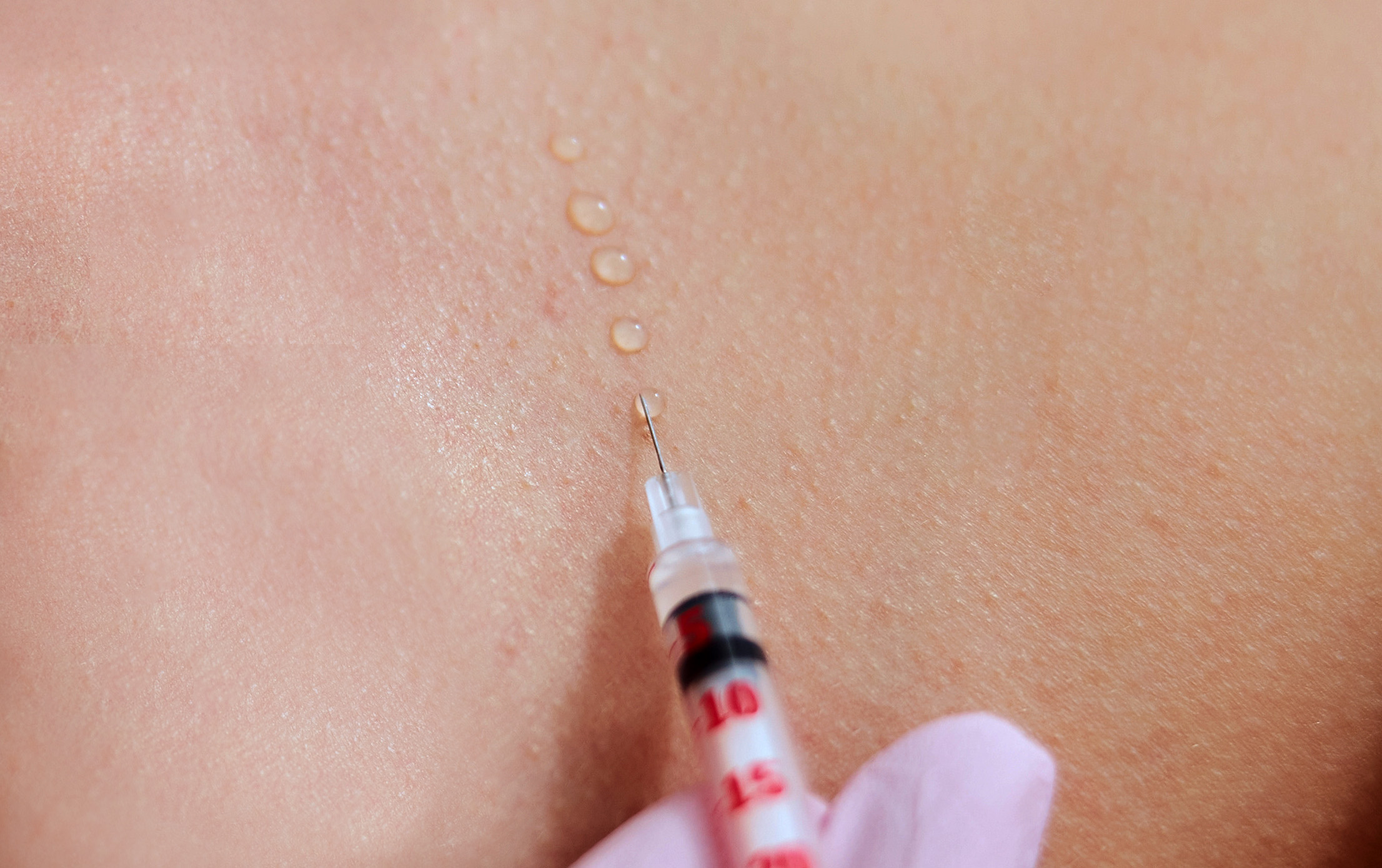 Woman getting a subcutaneous injection in a beauty clinic